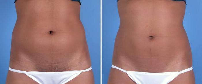Before & After CoolSculpting Case 25020 View #1 View in Alpharetta, GA