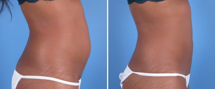 Before & After CoolSculpting Case 25020 View #2 View in Alpharetta, GA
