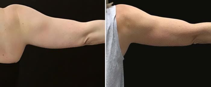 Before & After CoolSculpting Case 25030 View #1 View in Alpharetta, GA