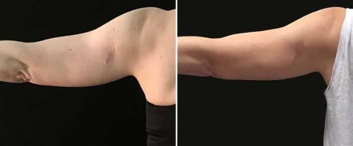 Before & After CoolSculpting Case 25030 View #2 View in Alpharetta, GA