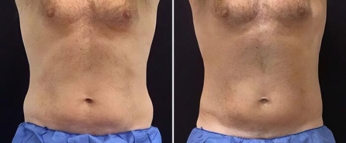 Before & After CoolSculpting Case 25033 View #1 View in Alpharetta, GA