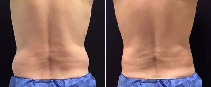 Before & After CoolSculpting Case 25033 View #2 View in Alpharetta, GA