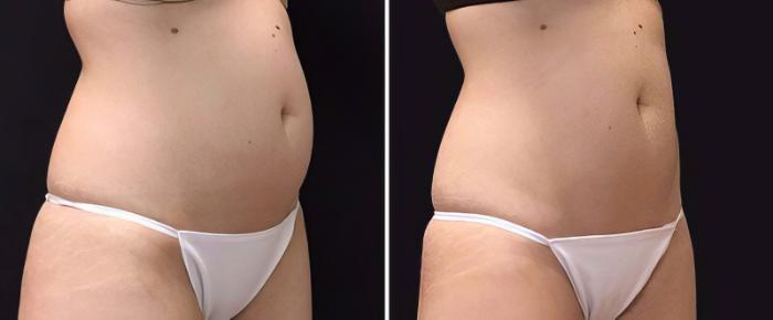 Before & After CoolSculpting Case 25036 View #1 View in Alpharetta, GA