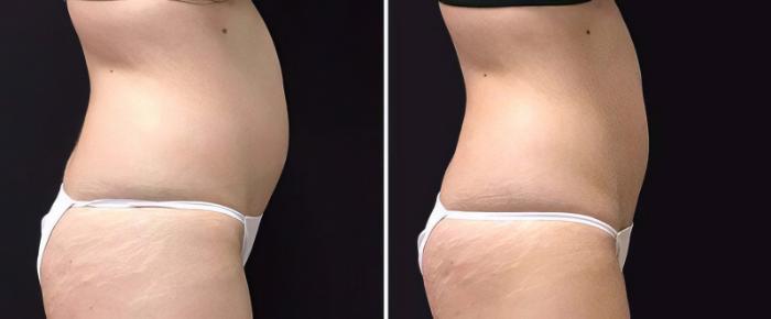 Before & After CoolSculpting Case 25036 View #2 View in Alpharetta, GA