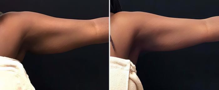 Before & After CoolSculpting Case 25039 View #1 View in Alpharetta, GA