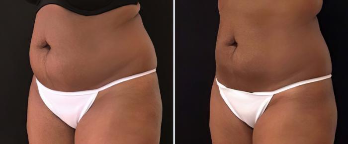 Before & After CoolSculpting Case 25042 View #1 View in Alpharetta, GA