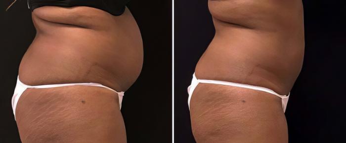 Before & After CoolSculpting Case 25042 View #2 View in Alpharetta, GA