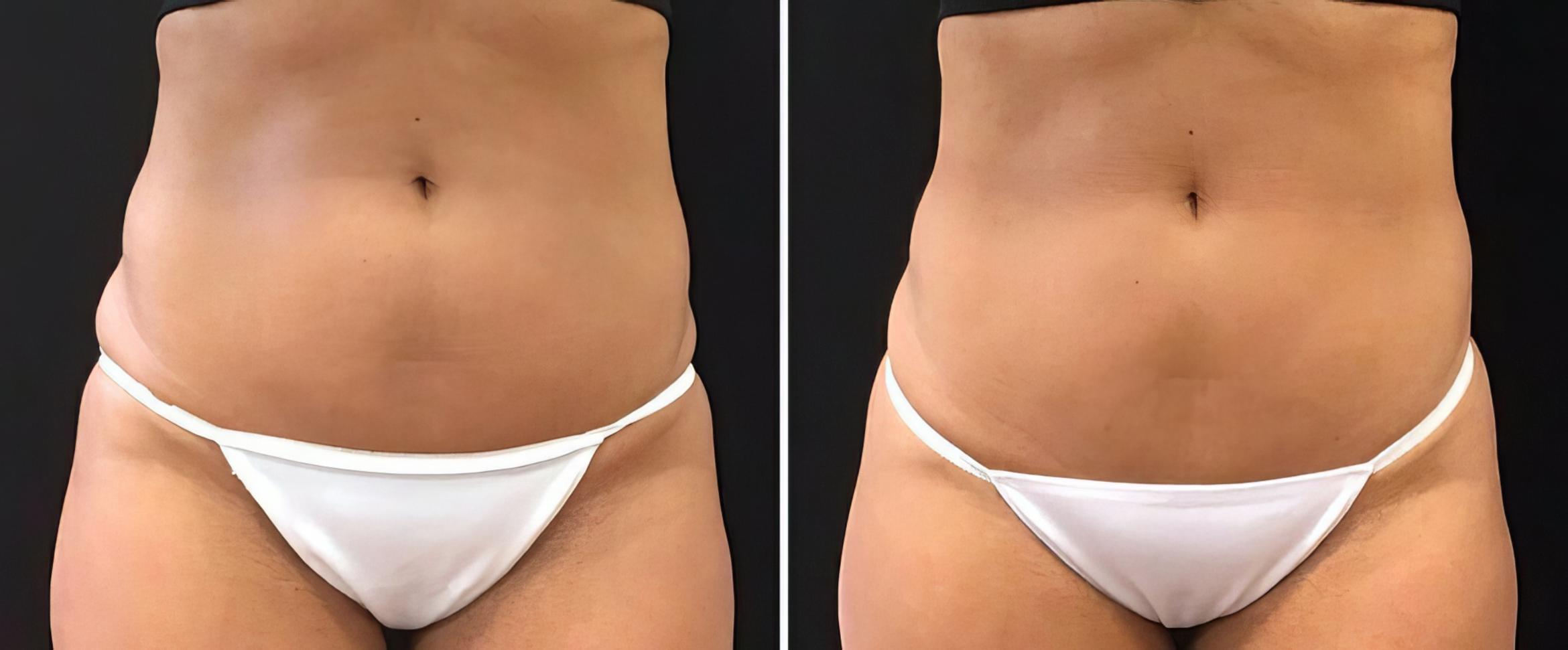 Before & After CoolSculpting Case 26499 View #1 View in Alpharetta, GA