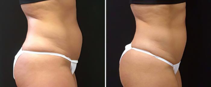 Before & After CoolSculpting Case 26499 View #2 View in Alpharetta, GA
