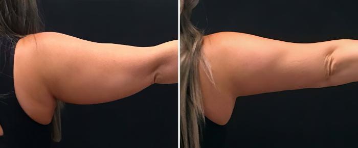 Before & After CoolSculpting Case 26502 View #1 View in Alpharetta, GA