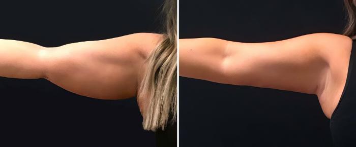 Before & After CoolSculpting Case 26502 View #2 View in Alpharetta, GA
