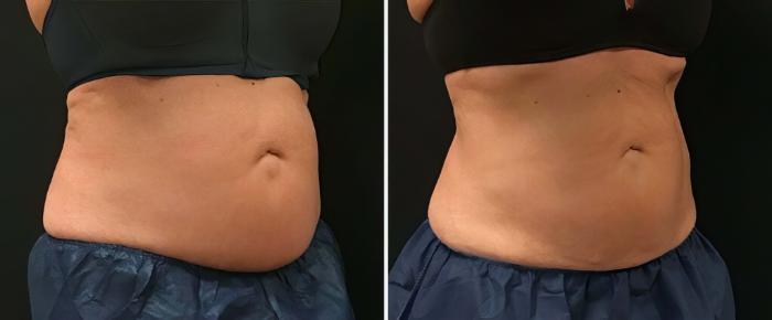 Before & After CoolSculpting Case 26505 View #1 View in Alpharetta, GA