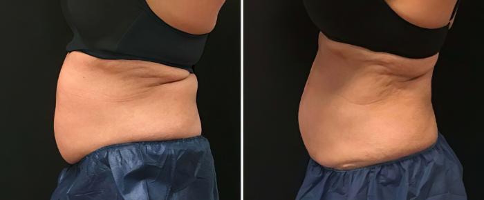 Before & After CoolSculpting Case 26505 View #2 View in Alpharetta, GA