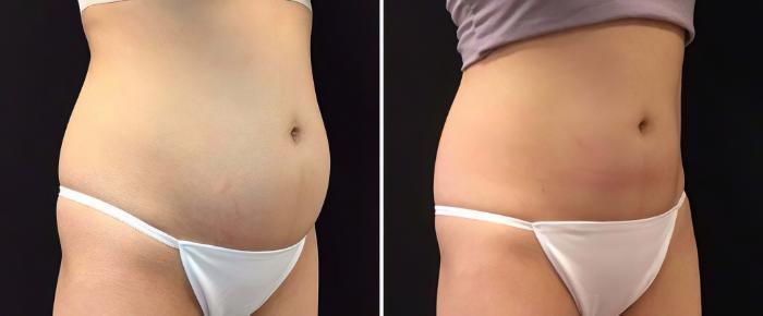 Before & After CoolSculpting Case 26526 View #1 View in Alpharetta, GA