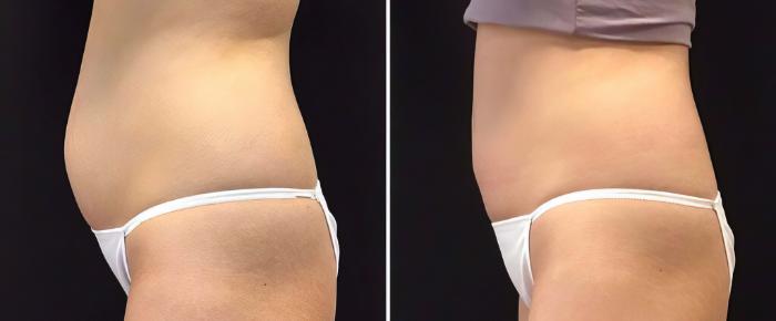 Before & After CoolSculpting Case 26526 View #2 View in Alpharetta, GA