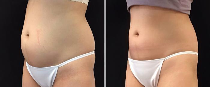 Before & After CoolSculpting Case 26526 View #3 View in Alpharetta, GA