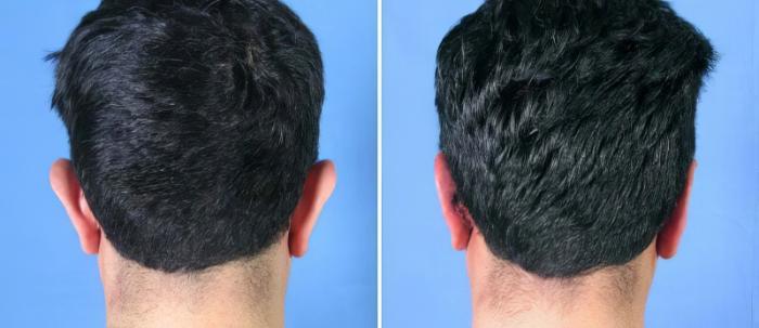 Before & After Ear Reshaping Case 17344 View #2 View in Alpharetta, GA