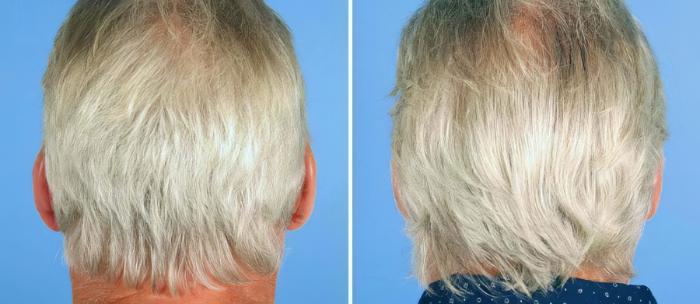 Before & After Ear Reshaping Case 17465 View #2 View in Alpharetta, GA