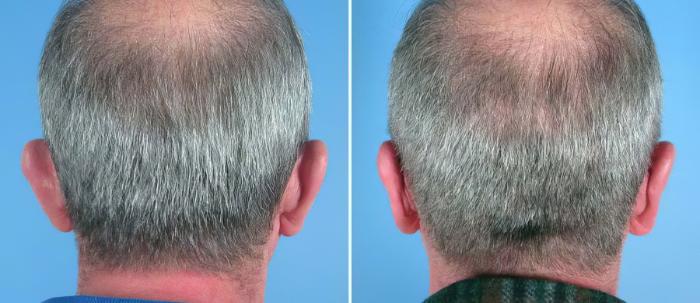 Before & After Ear Reshaping Case 17477 View #2 View in Alpharetta, GA