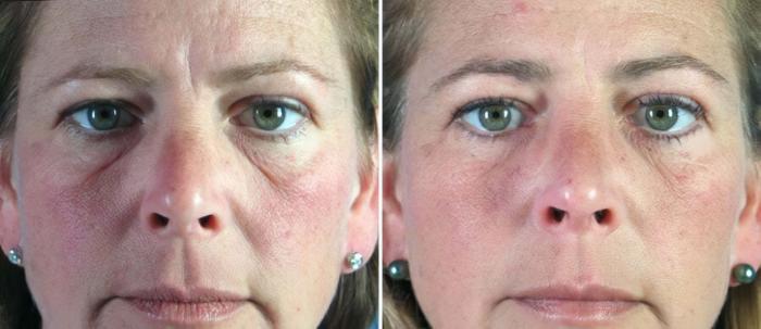 Before & After Eyelid Lift Case 16423 View #1 View in Alpharetta, GA