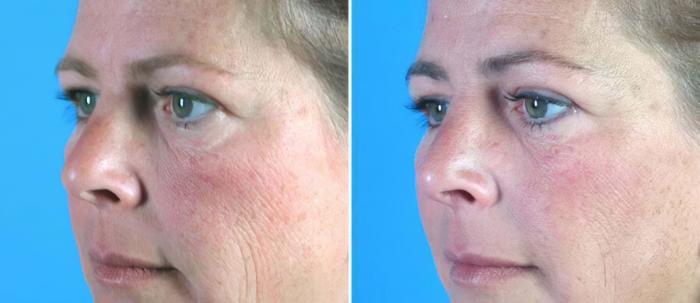 Before & After Eyelid Lift Case 16423 View #2 View in Alpharetta, GA