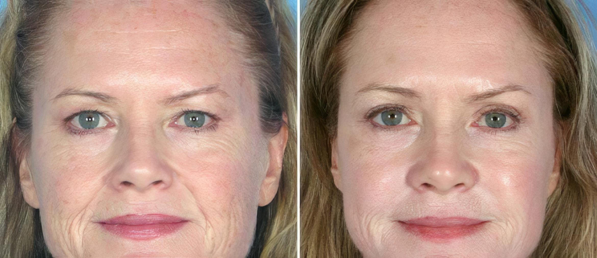 Before & After Eyelid Lift Case 17462 View #1 View in Alpharetta, GA