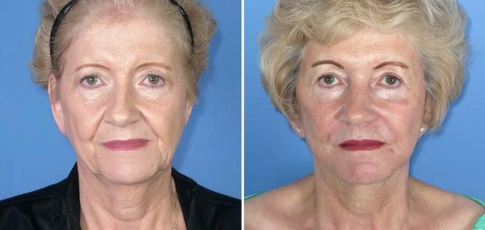 Before & After Eyelid Lift Case 17708 View #1 View in Alpharetta, GA