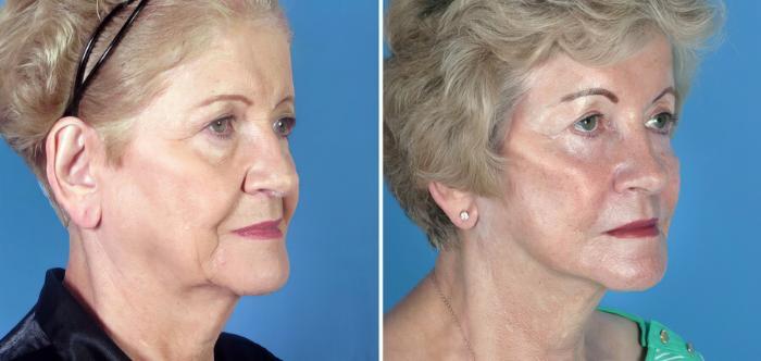 Before & After Eyelid Lift Case 17708 View #2 View in Alpharetta, GA