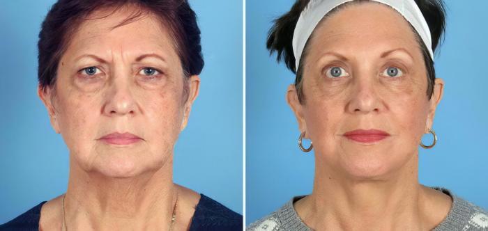 Before & After Eyelid Lift Case 17714 View #1 View in Alpharetta, GA
