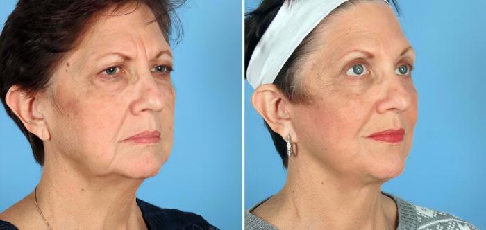 Before & After Eyelid Lift Case 17714 View #2 View in Alpharetta, GA