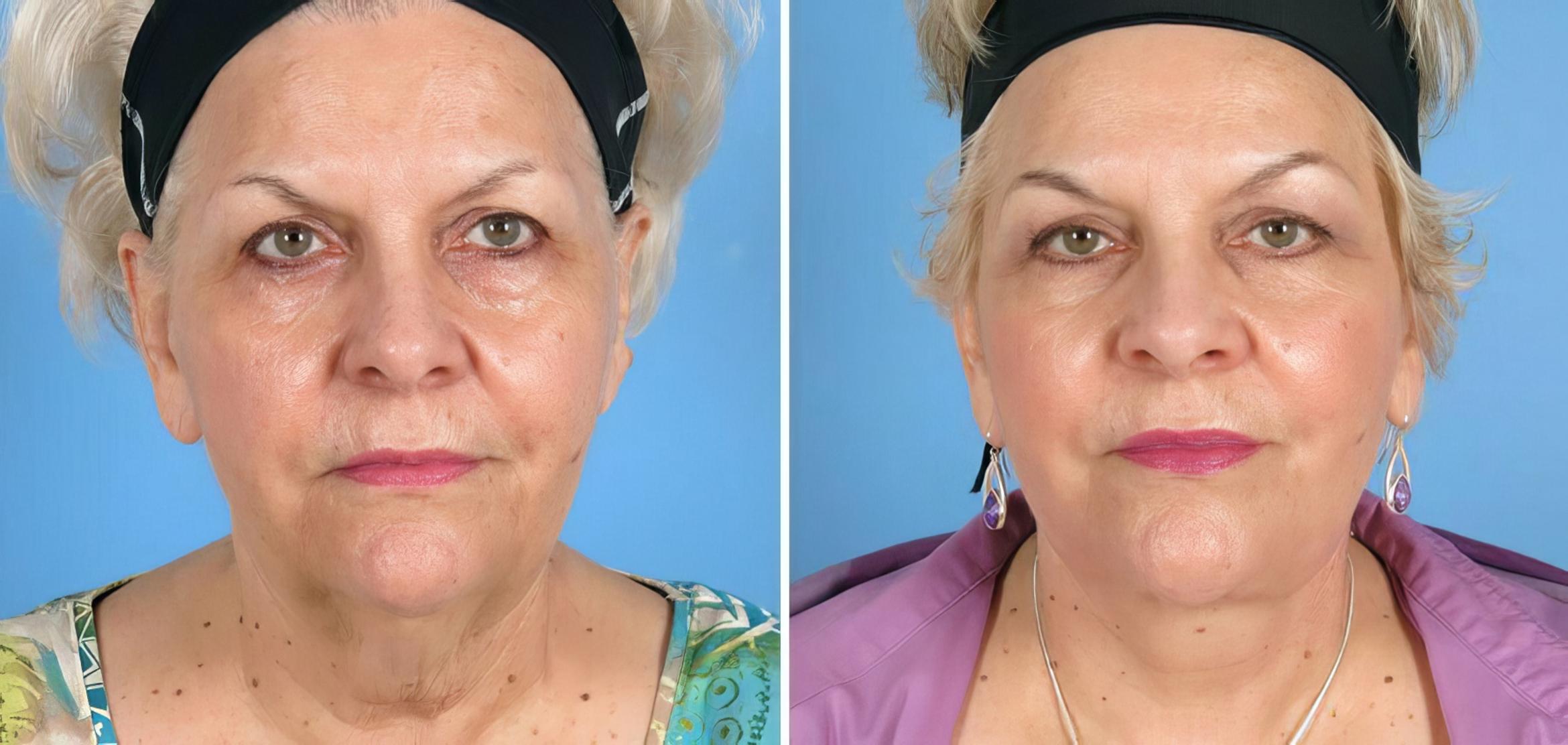 Before & After Eyelid Lift Case 17720 View #1 View in Alpharetta, GA