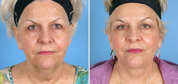 Before & After Eyelid Lift Case 17720 View #1 View in Alpharetta, GA