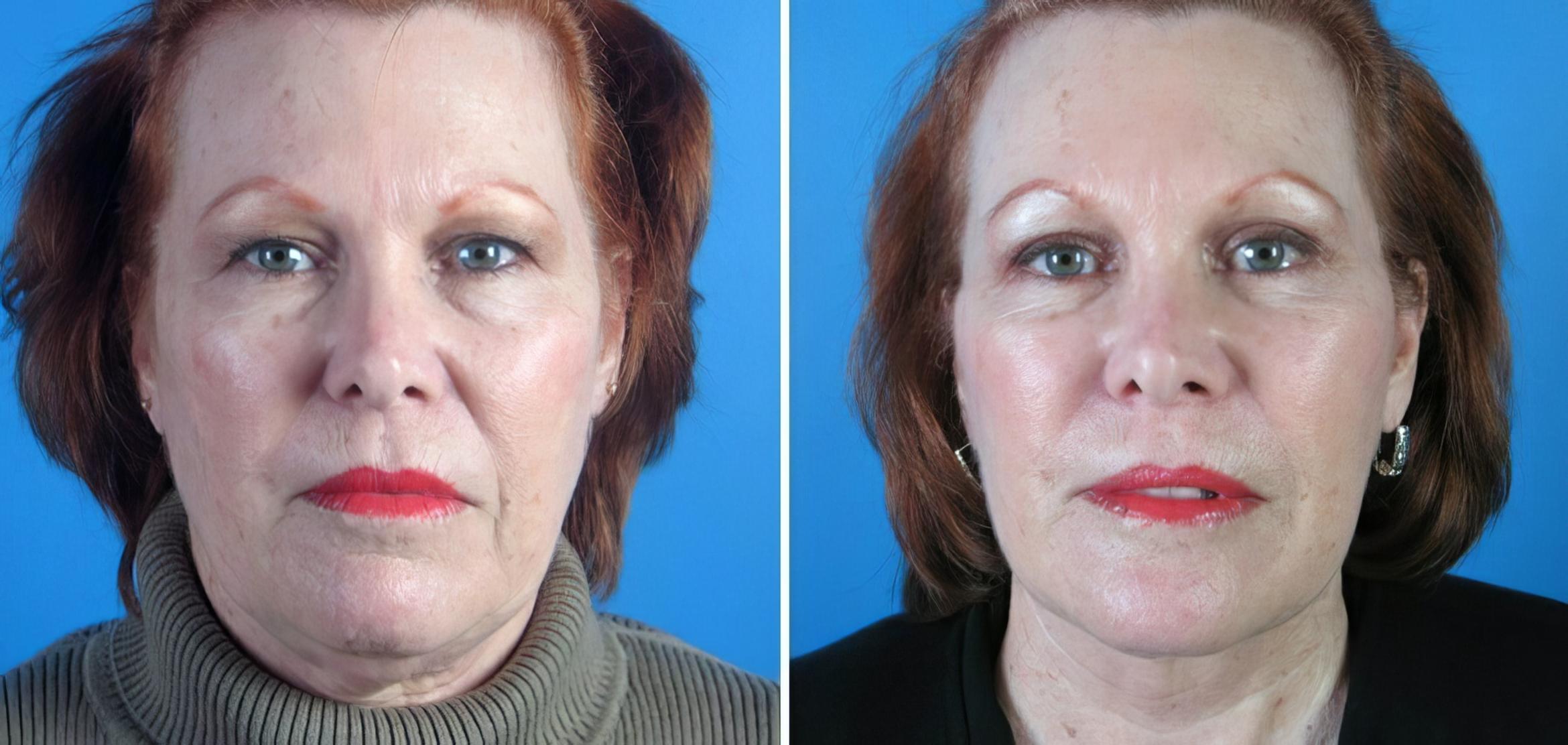 Before & After Eyelid Lift Case 17729 View #1 View in Alpharetta, GA
