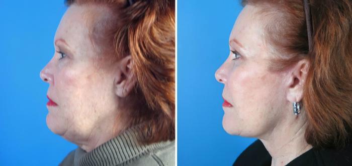 Before & After Eyelid Lift Case 17729 View #4 View in Alpharetta, GA
