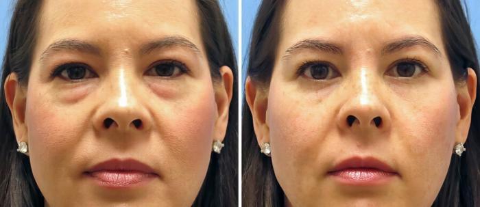 Before & After Eyelid Lift Case 17743 View #1 View in Alpharetta, GA