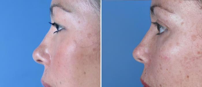 Before & After Eyelid Lift Case 18766 View #2 View in Alpharetta, GA