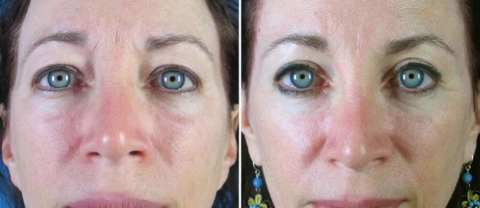 Before & After Eyelid Lift Case 18769 View #1 View in Alpharetta, GA