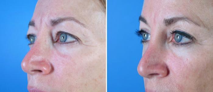 Before & After Eyelid Lift Case 18769 View #2 View in Alpharetta, GA