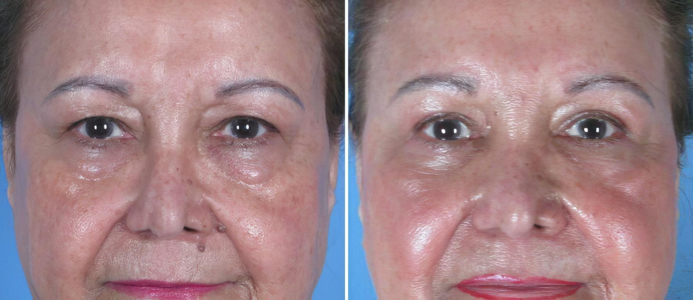 Before & After Eyelid Lift Case 18772 View #1 View in Alpharetta, GA