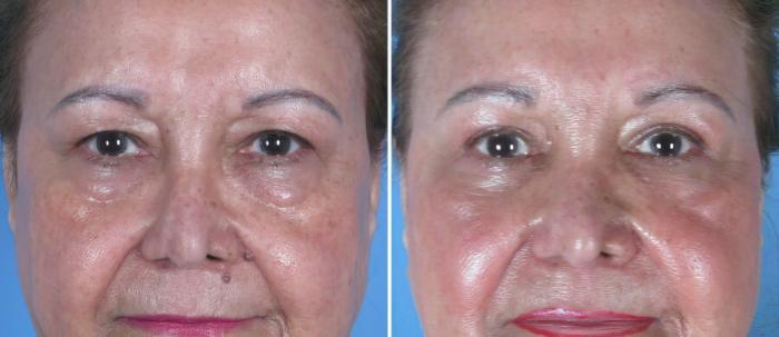 Before & After Eyelid Lift Case 18772 View #1 View in Alpharetta, GA