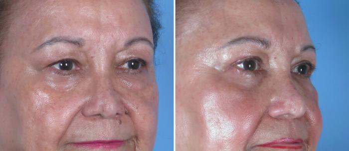 Before & After Eyelid Lift Case 18772 View #2 View in Alpharetta, GA