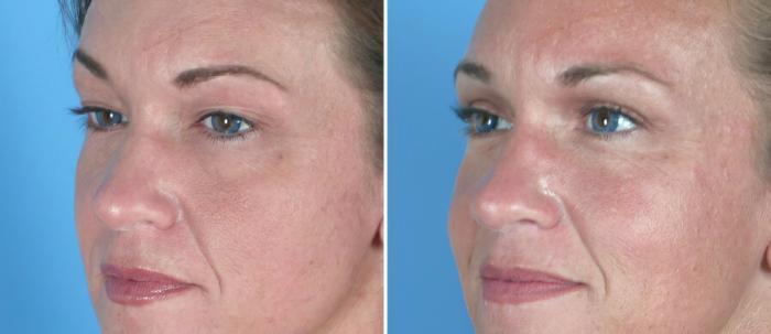 Before & After Eyelid Lift Case 18775 View #2 View in Alpharetta, GA