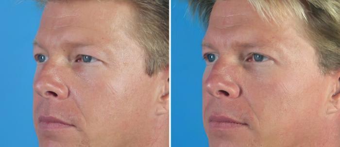 Before & After Eyelid Lift Case 18778 View #2 View in Alpharetta, GA