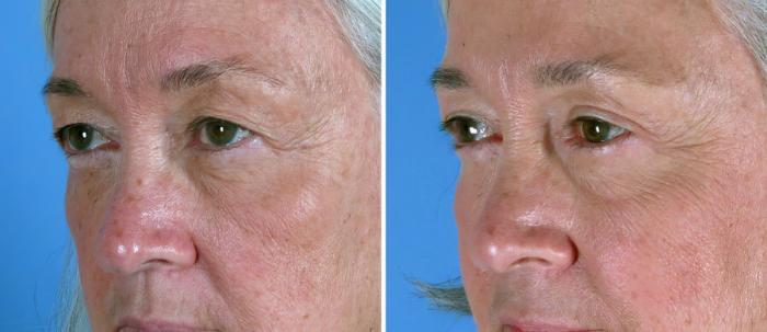 Before & After Eyelid Lift Case 19257 View #2 View in Alpharetta, GA