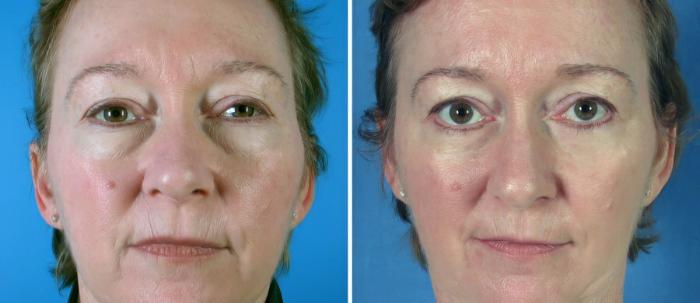 Before & After Eyelid Lift Case 19260 View #1 View in Alpharetta, GA