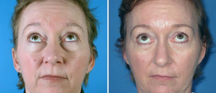 Before & After Eyelid Lift Case 19260 View #2 View in Alpharetta, GA