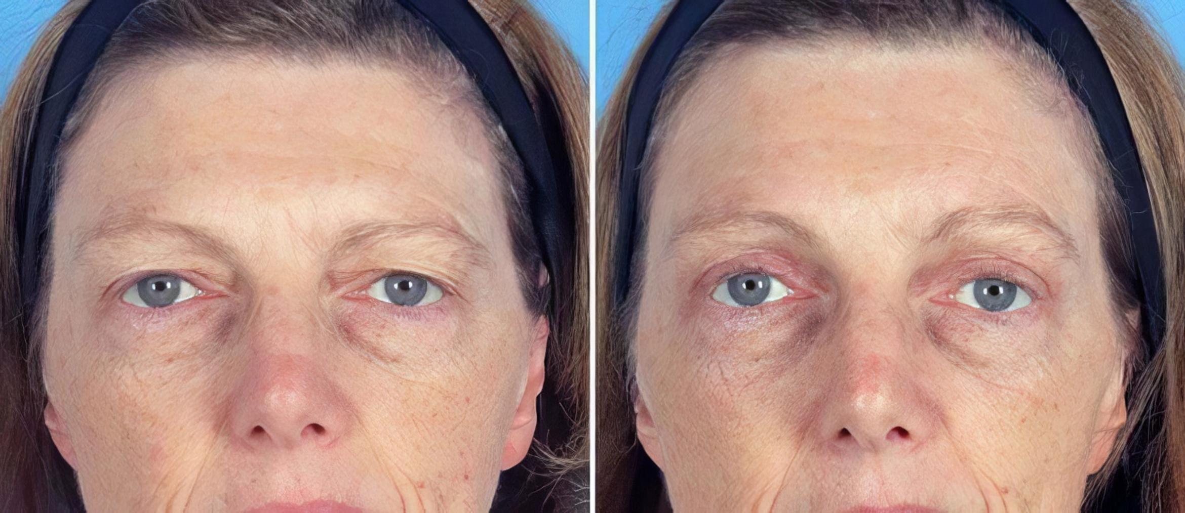 Before & After Eyelid Lift Case 19560 View #1 View in Alpharetta, GA