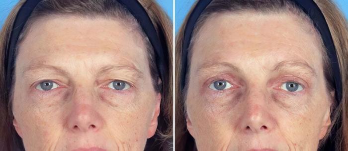 Before & After Eyelid Lift Case 19560 View #1 View in Alpharetta, GA