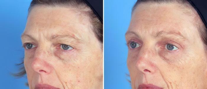 Before & After Eyelid Lift Case 19560 View #2 View in Alpharetta, GA