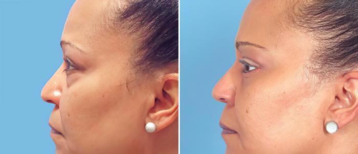 Before & After Eyelid Lift Case 26149 View #2 View in Alpharetta, GA